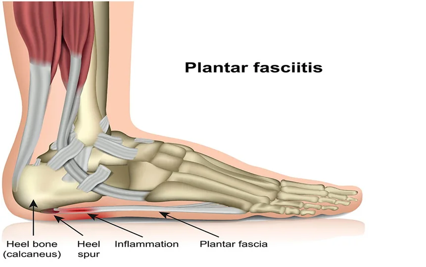 Understanding Plantar Fasciitis Why Does Your Heel Hurt