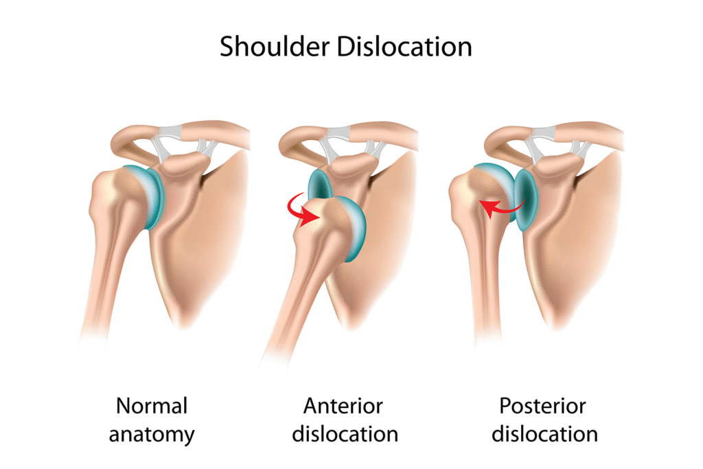 Shoulder instability treatment in Bangalore - BSI Physiotherapy